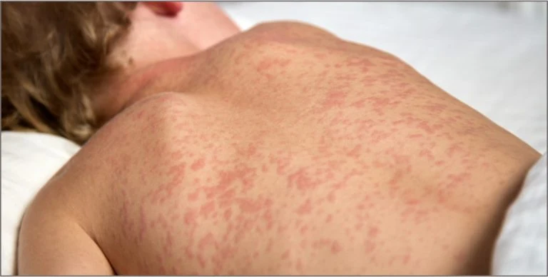 Sarampo: entenda sintomas, riscos e quando se vacinar